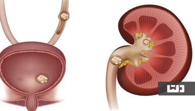 درمان سنگ کلیه