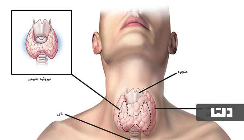 کم کاری تیروئید